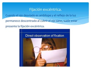 Fijación excéntrica.
Cuando el ojo desviado es ambliope y el reflejo de la luz
permanece descentrado al cubrir el ojo sano, suele estar
presente la fijación excéntrica.
 