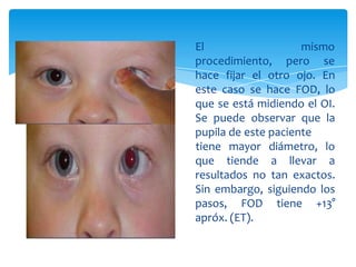 mismo
El
procedimiento, pero se
hace fijar el otro ojo. En
este caso se hace FOD, lo
que se está midiendo el OI.
Se puede observar que la
pupila de este paciente
que tiende a llevar
tiene mayor diámetro, lo
a
resultados no tan exactos.
Sin embargo, siguiendo los
pasos, FOD tiene +13°
apróx. (ET).
 