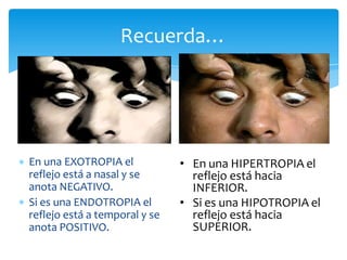 Recuerda…
En una EXOTROPIA el
reflejo está a nasal y se
anota NEGATIVO.
Si es una ENDOTROPIA el
reflejo está a temporal y se
anota POSITIVO.
• En una HIPERTROPIA el
reflejo está hacia
INFERIOR.
• Si es una HIPOTROPIA el
reflejo está hacia
SUPERIOR.
 
