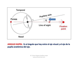Angulo kappa en oftalmologia