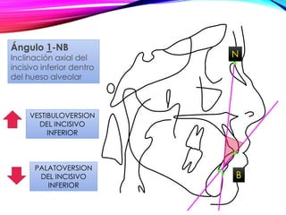 N
B
VESTIBULOVERSION
DEL INCISIVO
INFERIOR
PALATOVERSION
DEL INCISIVO
INFERIOR
Ángulo 1-NB
Inclinación axial del
incisivo inferior dentro
del hueso alveolar
 