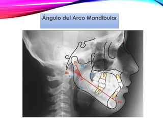 Ángulo del Arco Mandibular
 