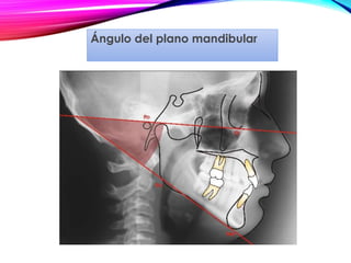 Ángulo del plano mandibular
 