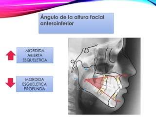 Ángulo de la altura facial
anteroinferior
MORDIDA
ABIERTA
ESQUELETICA
MORDIDA
ESQUELETICA
PROFUNDA
 