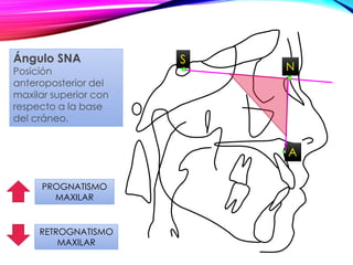 S
N
A
PROGNATISMO
MAXILAR
RETROGNATISMO
MAXILAR
Ángulo SNA
Posición
anteroposterior del
maxilar superior con
respecto a la base
del cráneo.
 