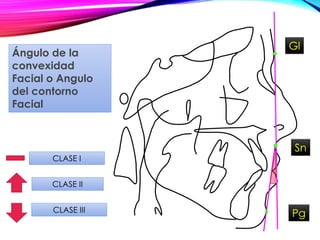 Sn
Gl
Pg
CLASE II
CLASE III
Ángulo de la
convexidad
Facial o Angulo
del contorno
Facial
CLASE I
 