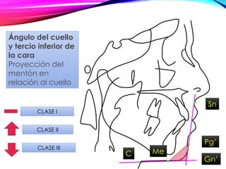 Sn
Pg’
CLASE II
CLASE III
Ángulo del cuello
y tercio inferior de
la cara
Proyección del
mentón en
relación al cuello
CLASE I
C Me
Gn’
 
