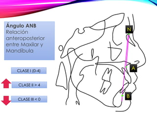 A
N
CLASE II > 4
CLASE III < 0
Ángulo ANB
Relación
anteroposterior
entre Maxilar y
Mandíbula
B
CLASE I (0-4)
 