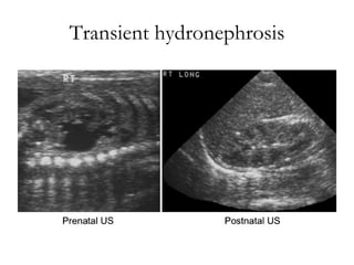 Transient hydronephrosis 