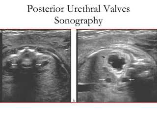 Posterior Urethral Valves Sonography 