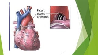 Patent ductus arteriosus child health nu | PPTX