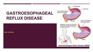 GASTROESOPHAGEAL
REFLUX DISEASE
ANIL DHAKAL
 