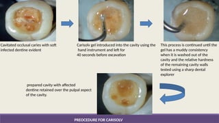 endodontics ANILA-NON ROTARY METHODS.pptx