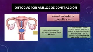 Anillo de cotracciones y distocias dinamica uterina