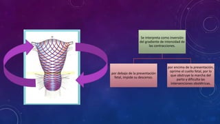 Anillo de cotracciones y distocias dinamica uterina