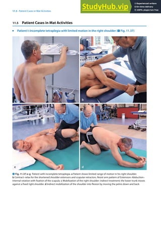11
231
11.5 · Patient Cases in Mat Activities
11.5 Patient Cases in Mat Activities
j
Patient I: Incomplete tetraplegia with limited motion in the right shoulder (. Fig. 11.37)
. Fig. 11.37 a–g Patient with incomplete tetraplegia. a Patient shows limited range of motion in his right shoulder.
b Contract–relax for the shortened shoulder extensors and scapular retractors. Resist arm pattern of Extension–Abduction–
Internal rotation with fixation of the scapula. c Mobilization of the right shoulder: indirect treatment; the lower trunk moves
against a fixed right shoulder. d Indirect mobilization of the shoulder into flexion by moving the pelvis down and back
 