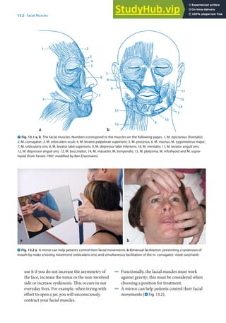 13
277
13.2 · Facial Muscles
use it if you do not increase the asymmetry of
the face, increase the tonus in the non-involved
side or increase synkinesis. This occurs in our
everyday lives. For example, when trying with
effort to open a jar, you will unconsciously
contract your facial muscles.
. Fig. 13.1 a, b The facial muscles. Numbers correspond to the muscles on the following pages. 1, M. epicranius (frontalis);
2, M. corrugator; 3, M. orbicularis oculi; 4, M. levator palpebrae superioris; 5, M. procerus; 6, M. risorius, M. zygomaticus major;
7, M. orbicularis oris; 8, M. levator labii superioris; 9, M. depressor labii inferioris; 10, M. mentalis; 11, M. levator anguli oris;
12, M. depressor anguli oris; 13, M. buccinator; 14, M. masseter, M. temporalis; 15, M. platysma, M. infrahyoid and M. supra-
hyoid (from Feneis 1967, modified by Ben Eisermann)
4 Functionally, the facial muscles must work
against gravity; this must be considered when
choosing a position for treatment.
4 A mirror can help patients control their facial
movements (. Fig. 13.2).
. Fig. 13.2 a A mirror can help patients control their facial movements. b Bimanual facilitation: preventing a synkinesis of
mouth by make a kissing movement (orbicularis oris) and simultaneous facilitation of the m. corrugator: »look surprised«
a b
b
a
 