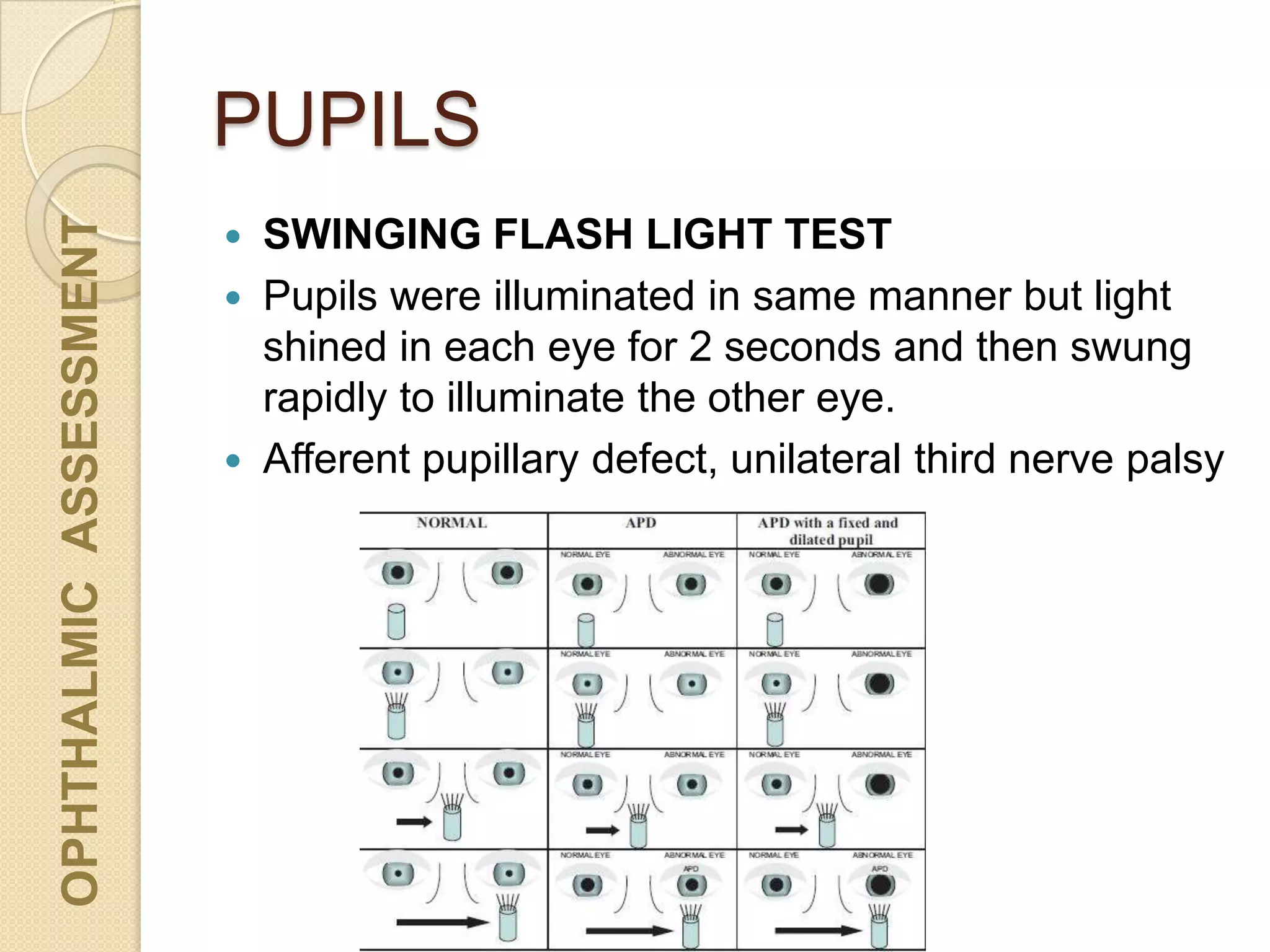 PUPILS
OPHTHALMICASSESSMENT
 SWINGING FLASH LIGHT TEST
 Pupils were illuminated in same manner but light
shined in each eye for 2 seconds and then swung
rapidly to illuminate the other eye.
 Afferent pupillary defect, unilateral third nerve palsy
 