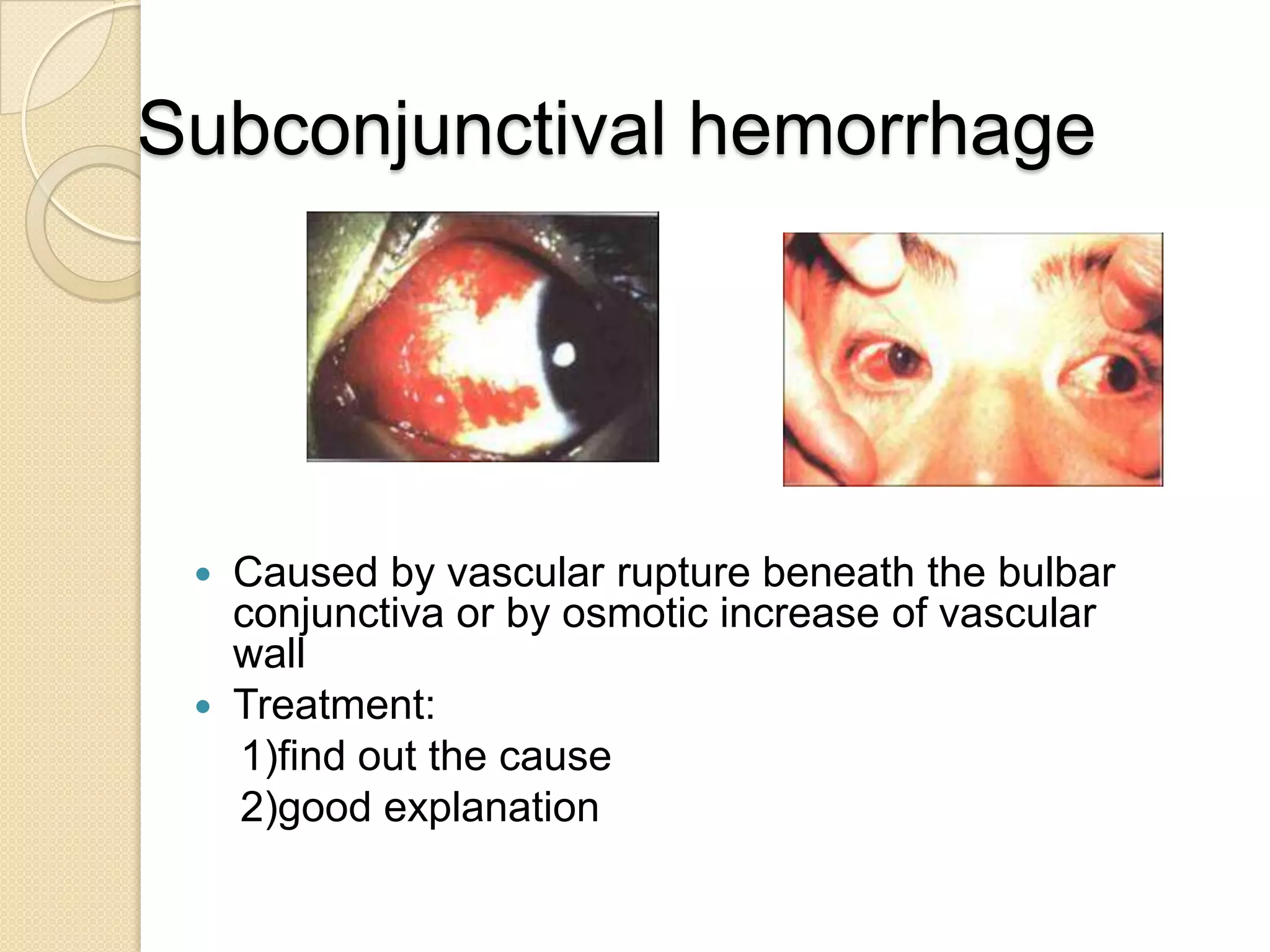 Subconjunctival hemorrhage
 Caused by vascular rupture beneath the bulbar
conjunctiva or by osmotic increase of vascular
wall
 Treatment:
1)find out the cause
2)good explanation
 