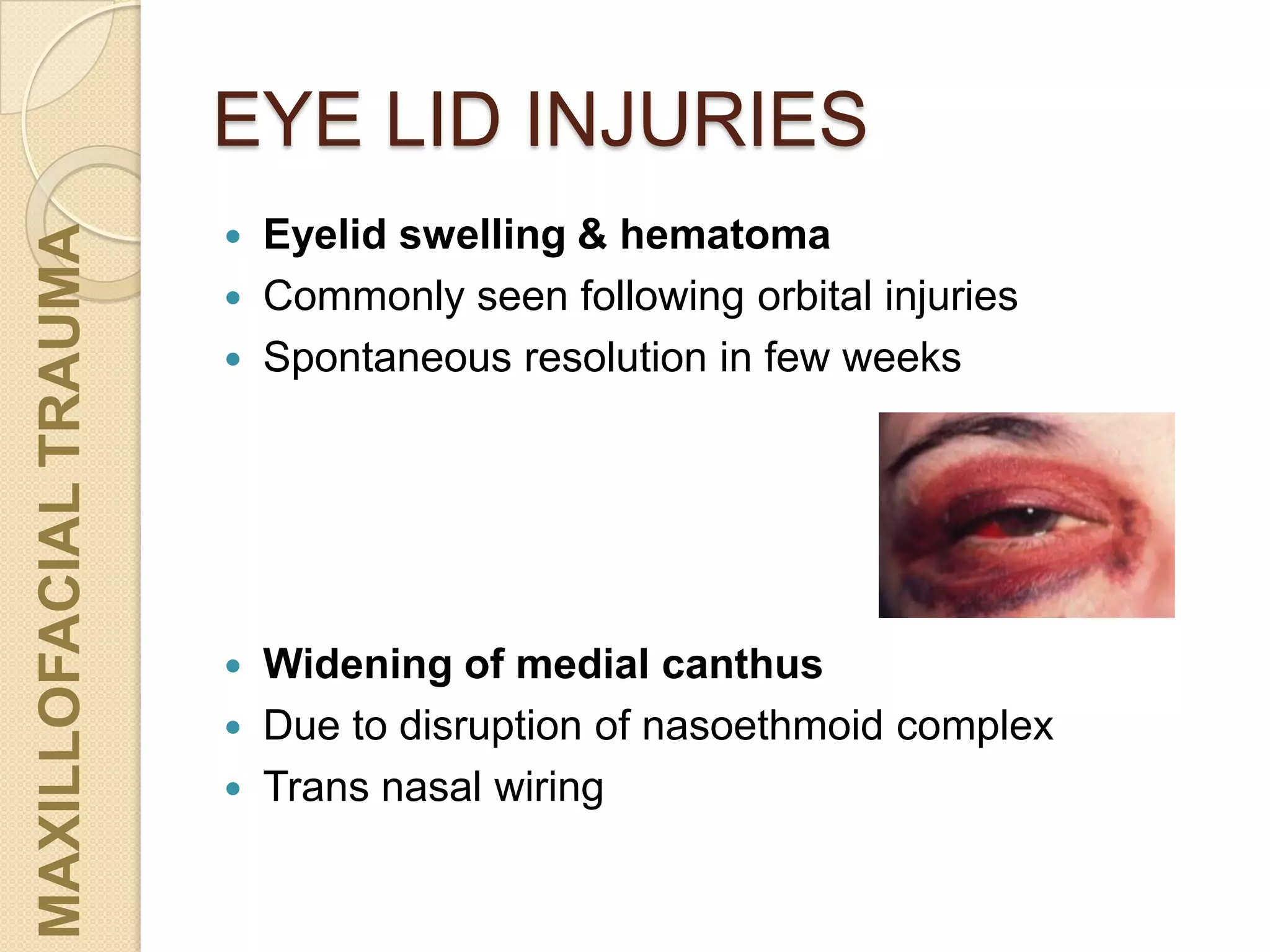 EYE LID INJURIES
MAXILLOFACIALTRAUMA
 Eyelid swelling & hematoma
 Commonly seen following orbital injuries
 Spontaneous resolution in few weeks
 Widening of medial canthus
 Due to disruption of nasoethmoid complex
 Trans nasal wiring
 