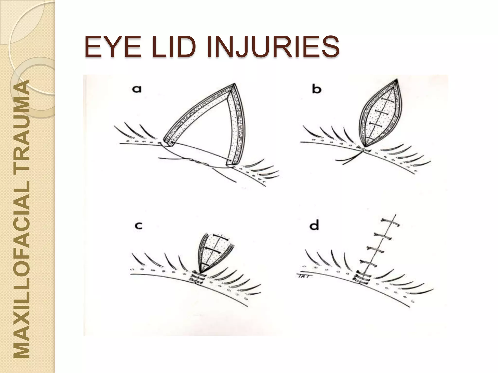 EYE LID INJURIES
MAXILLOFACIALTRAUMA
 