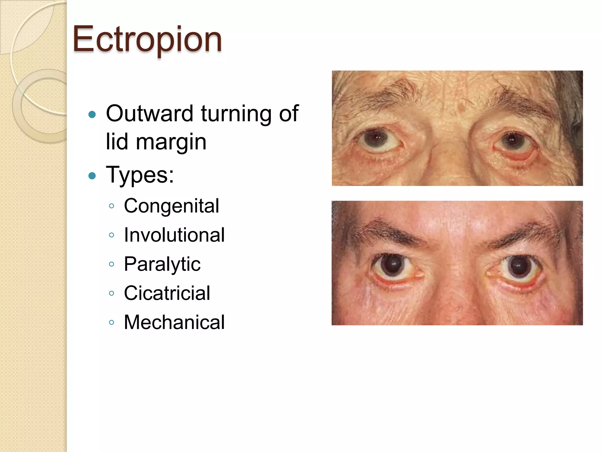 Ectropion
 Outward turning of
lid margin
 Types:
◦ Congenital
◦ Involutional
◦ Paralytic
◦ Cicatricial
◦ Mechanical
 