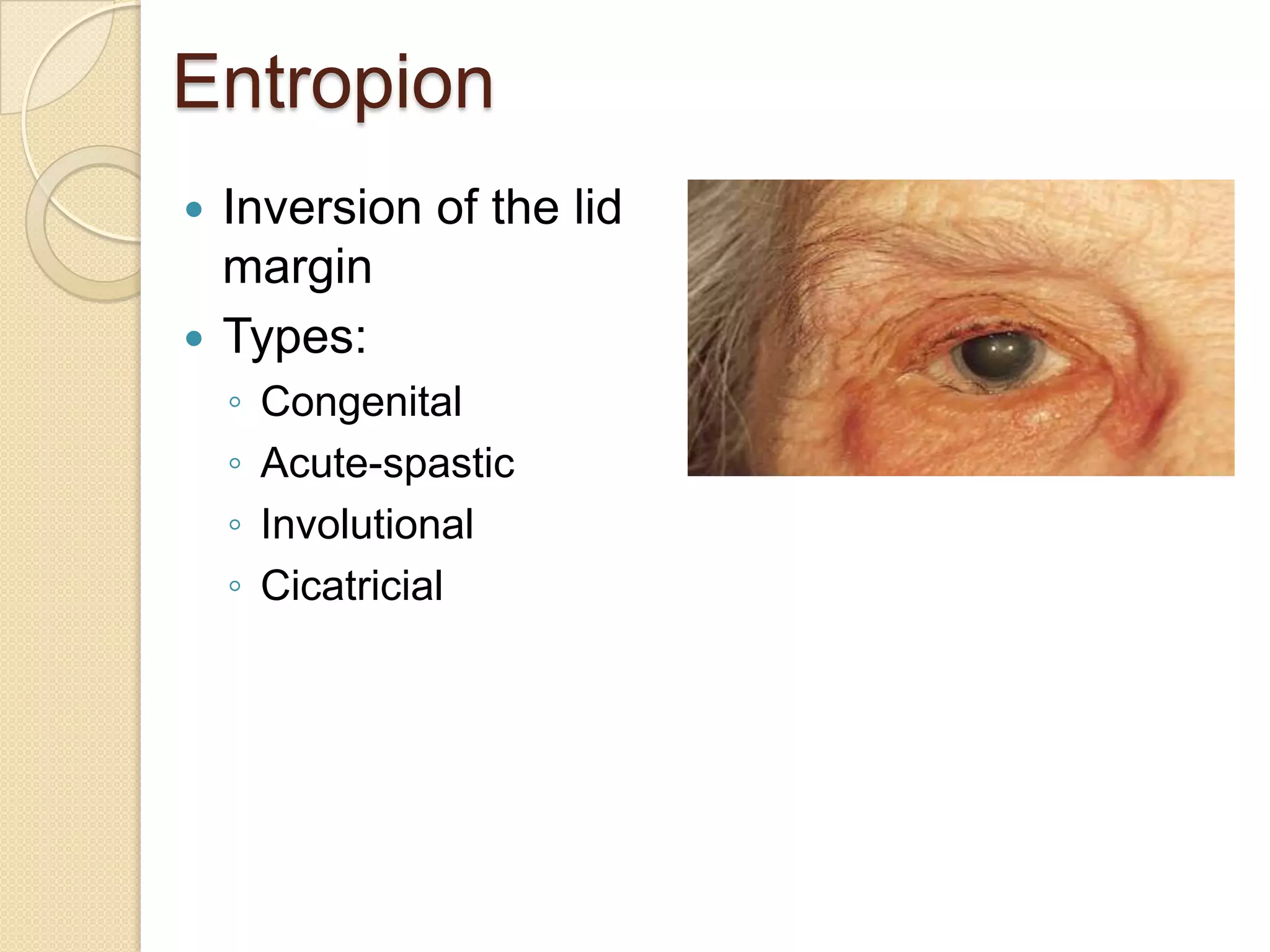 Entropion
 Inversion of the lid
margin
 Types:
◦ Congenital
◦ Acute-spastic
◦ Involutional
◦ Cicatricial
 