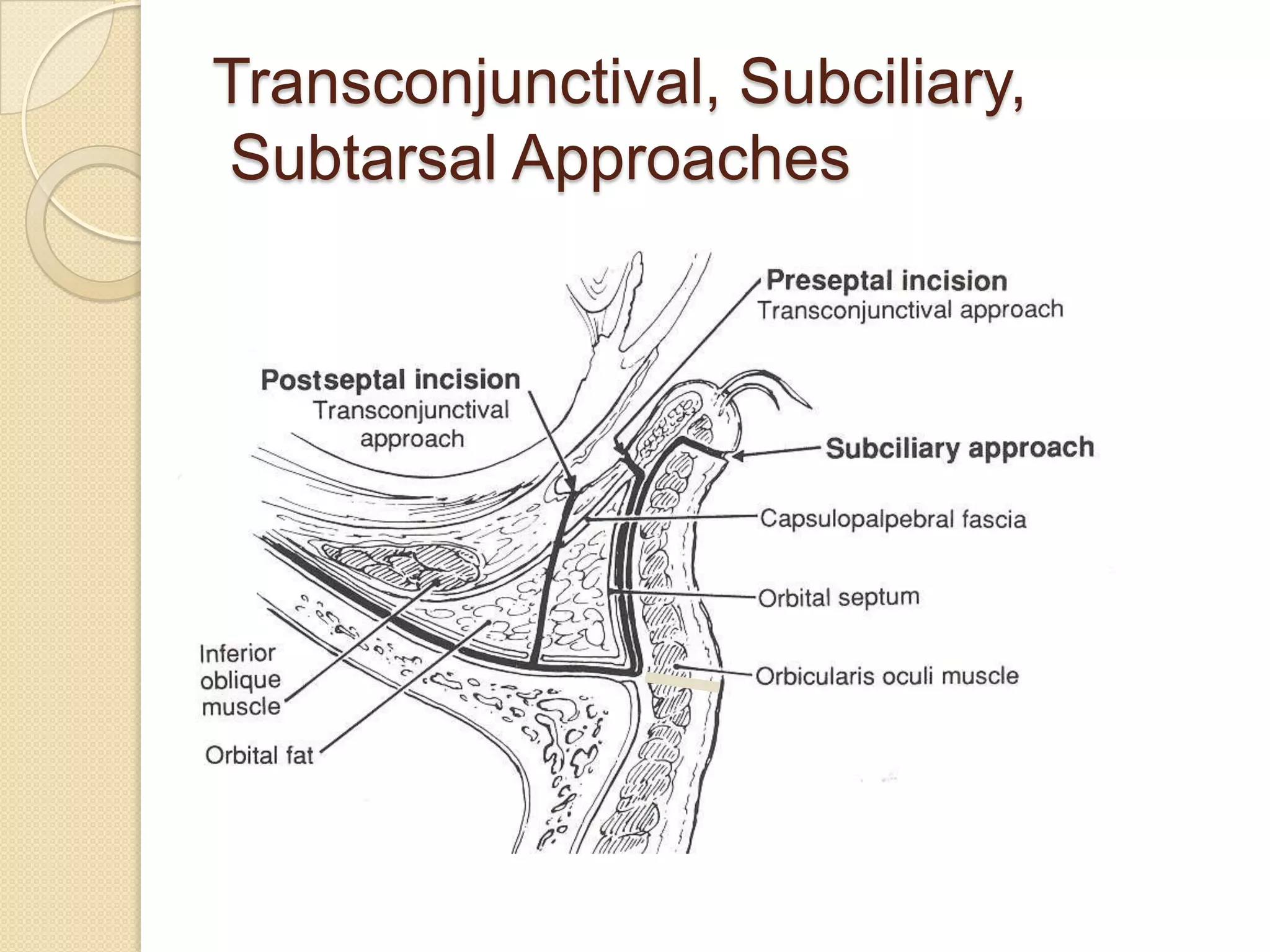 Transconjunctival, Subciliary,
Subtarsal Approaches
 