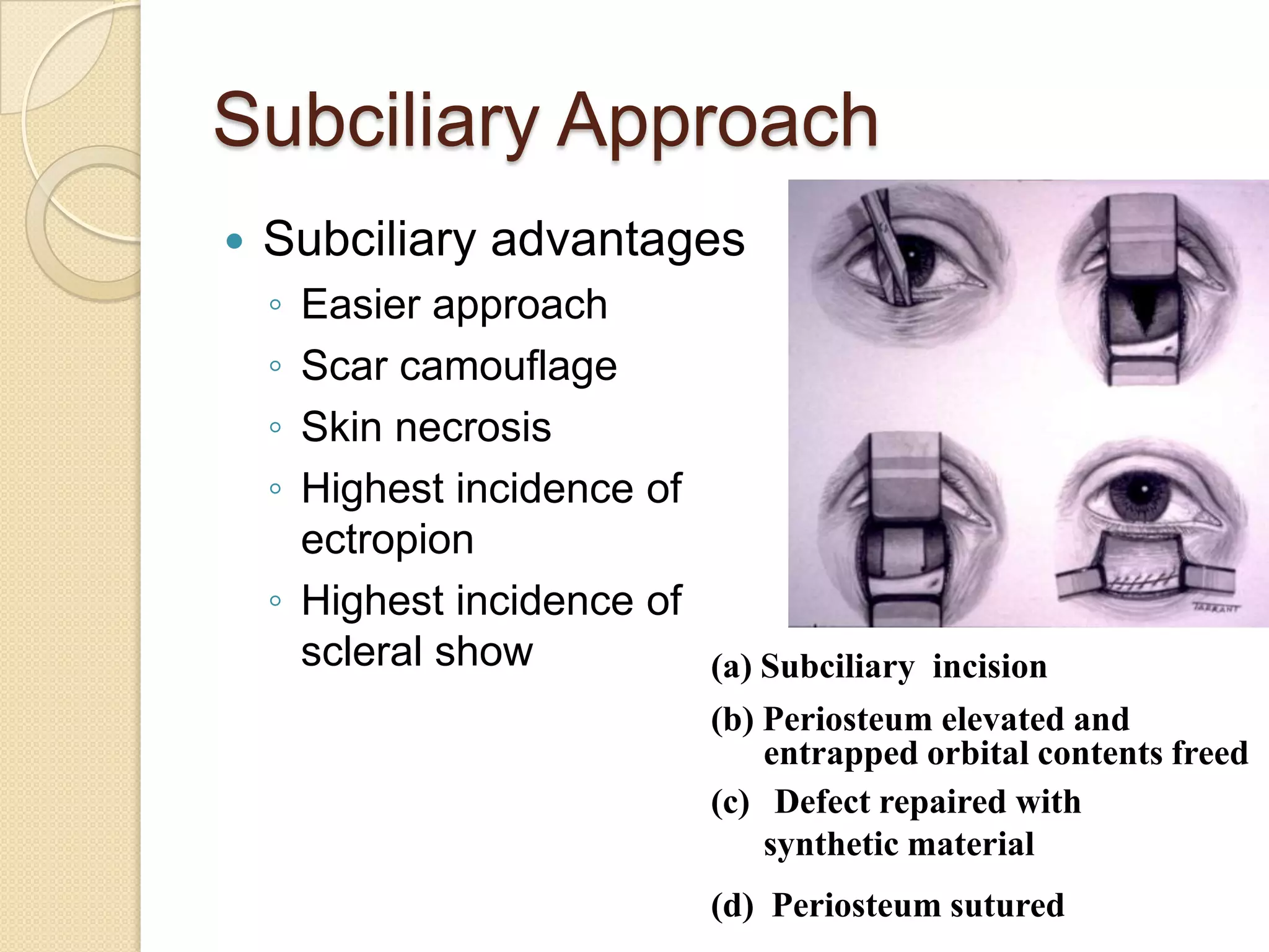 Subciliary Approach
 Subciliary advantages
◦ Easier approach
◦ Scar camouflage
◦ Skin necrosis
◦ Highest incidence of
ectropion
◦ Highest incidence of
scleral show (a) Subciliary incision
(b) Periosteum elevated and
entrapped orbital contents freed
(c) Defect repaired with
synthetic material
(d) Periosteum sutured
 
