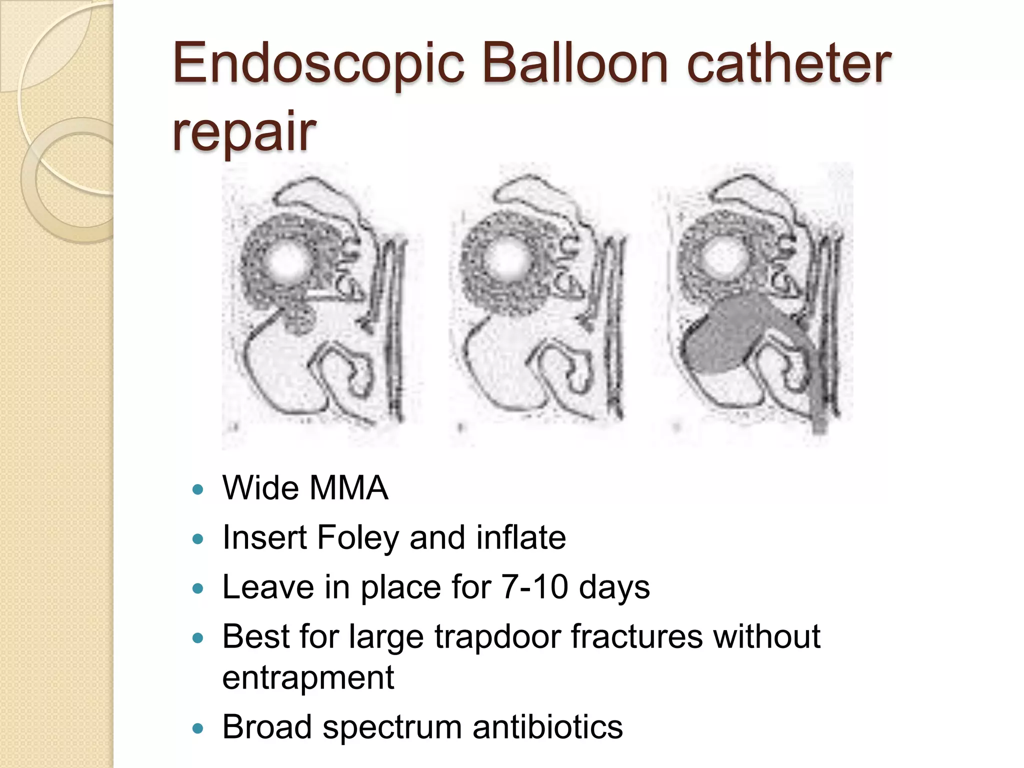 Endoscopic Balloon catheter
repair
 Wide MMA
 Insert Foley and inflate
 Leave in place for 7-10 days
 Best for large trapdoor fractures without
entrapment
 Broad spectrum antibiotics
 