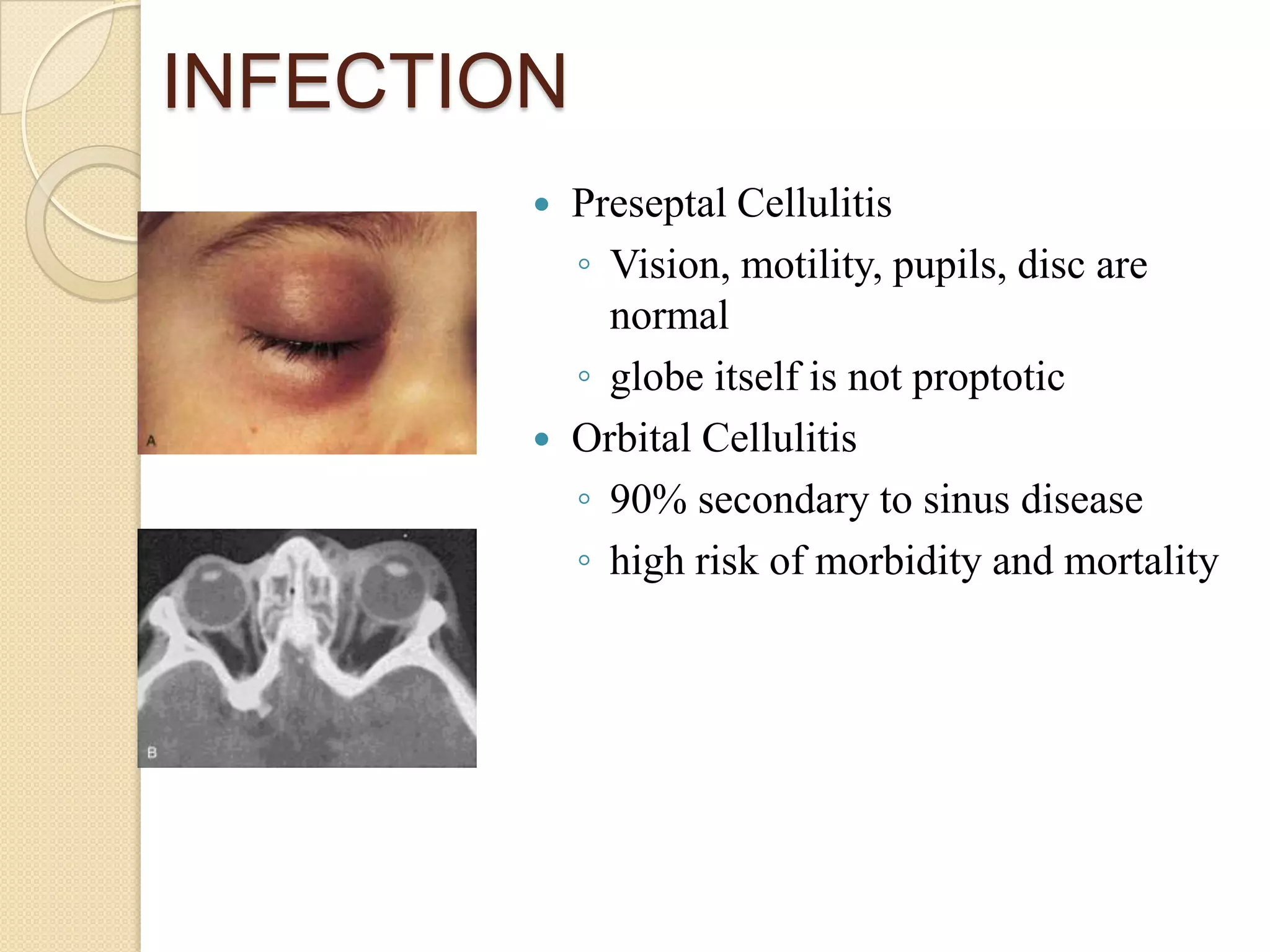 INFECTION
 Preseptal Cellulitis
◦ Vision, motility, pupils, disc are
normal
◦ globe itself is not proptotic
 Orbital Cellulitis
◦ 90% secondary to sinus disease
◦ high risk of morbidity and mortality
 