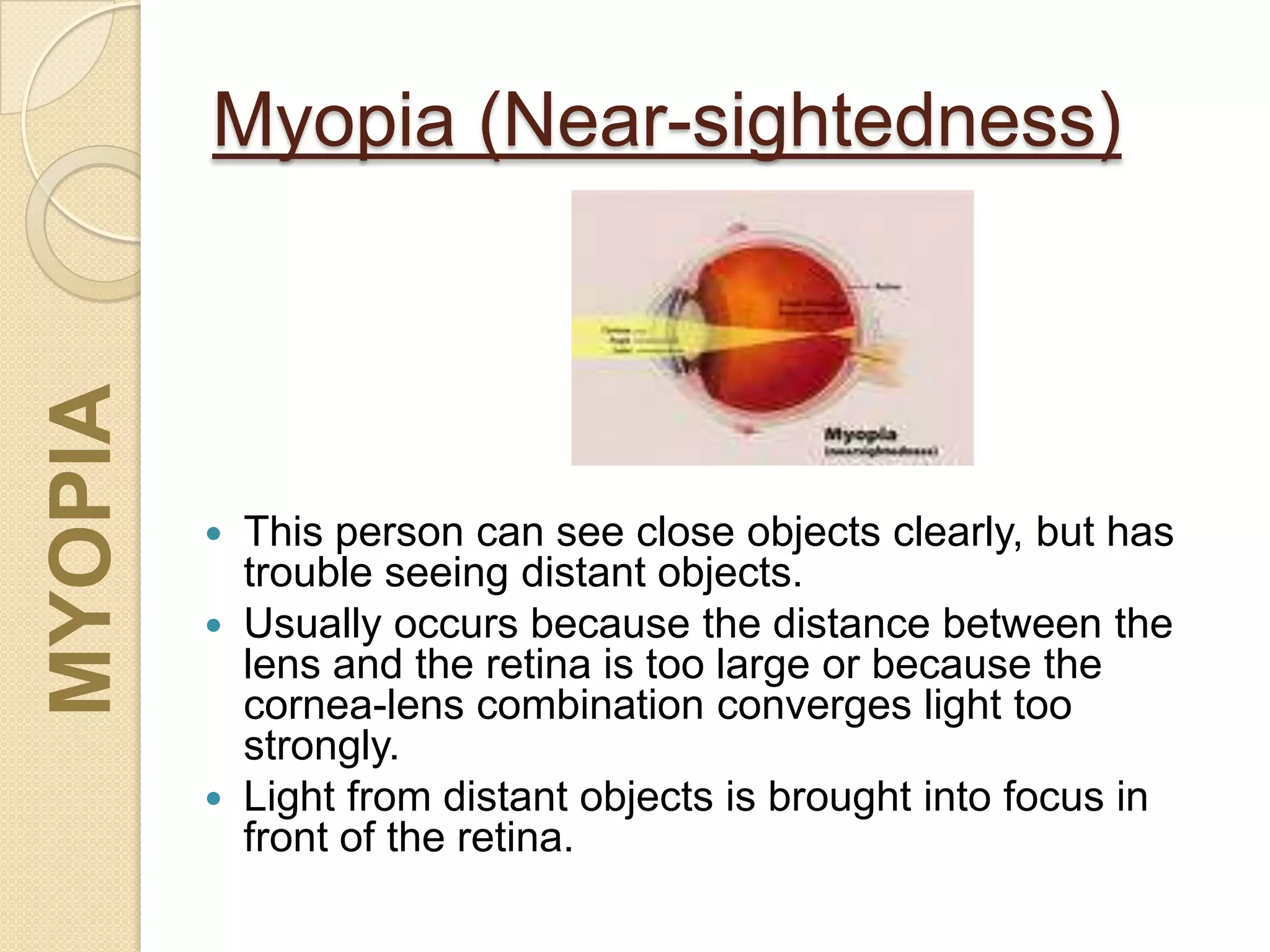 Myopia (Near-sightedness)
 This person can see close objects clearly, but has
trouble seeing distant objects.
 Usually occurs because the distance between the
lens and the retina is too large or because the
cornea-lens combination converges light too
strongly.
 Light from distant objects is brought into focus in
front of the retina.
MYOPIA
 