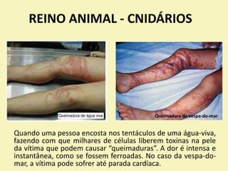 REINO ANIMAL - CNIDÁRIOS
Quando uma pessoa encosta nos tentáculos de uma água-viva,
fazendo com que milhares de células liberem toxinas na pele
da vítima que podem causar “queimaduras”. A dor é intensa e
instantânea, como se fossem ferroadas. No caso da vespa-do-
mar, a vítima pode sofrer até parada cardíaca.
Queimadura de vespa-do-mar
 