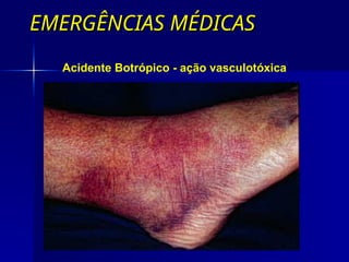 EMERGÊNCIAS MÉDICAS
EMERGÊNCIAS MÉDICAS
Acidente Botrópico - ação vasculotóxica
 