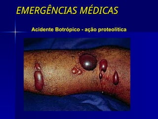 EMERGÊNCIAS MÉDICAS
EMERGÊNCIAS MÉDICAS
Acidente Botrópico - ação proteolítica
 