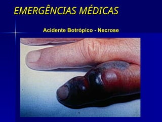 EMERGÊNCIAS MÉDICAS
EMERGÊNCIAS MÉDICAS
Acidente Botrópico - Necrose
 