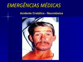 EMERGÊNCIAS MÉDICAS
EMERGÊNCIAS MÉDICAS
Acidente Crotálico - Neurotóxica
 