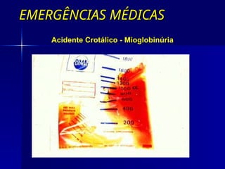 EMERGÊNCIAS MÉDICAS
EMERGÊNCIAS MÉDICAS
Acidente Crotálico - Mioglobinúria
 