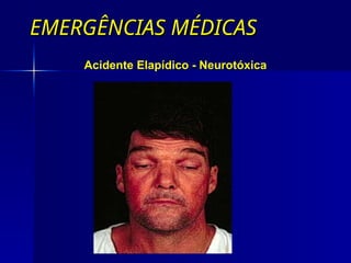 EMERGÊNCIAS MÉDICAS
EMERGÊNCIAS MÉDICAS
Acidente Elapídico - Neurotóxica
 