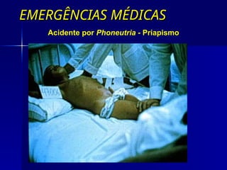 EMERGÊNCIAS MÉDICAS
EMERGÊNCIAS MÉDICAS
Acidente por Phoneutria - Priapismo
 