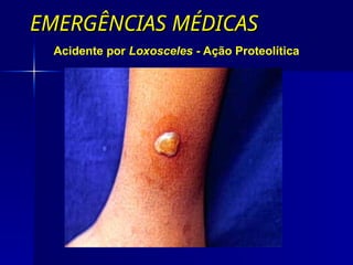 EMERGÊNCIAS MÉDICAS
EMERGÊNCIAS MÉDICAS
Acidente por Loxosceles - Ação Proteolítica
 