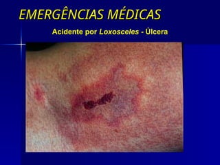 EMERGÊNCIAS MÉDICAS
EMERGÊNCIAS MÉDICAS
Acidente por Loxosceles - Úlcera
 