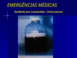 EMERGÊNCIAS MÉDICAS
EMERGÊNCIAS MÉDICAS
Acidente por Loxosceles - Urina escura
 
