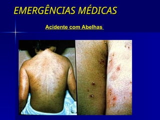 EMERGÊNCIAS MÉDICAS
EMERGÊNCIAS MÉDICAS
Acidente com Abelhas
 