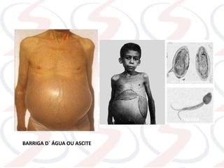 OVOS DE ESQUISTOSSOMO
CERCÁRIA
BARRIGA D` ÁGUA OU ASCITE
 