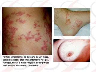 Rastros semelhantes ao desenho de um mapa,
estes localizados predominantemente nos pés,
nádegas, costas e mãos – regiões do corpo que
mais entram em contato com o solo.
 