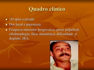 Quadro clínico
 1H após a picada
 Dor local e parestesia
 Fraqueza muscular progressiva, ptose palpebral,
oftalmoplegia, fácie miastênica, dificuldade p
deglutir, IRA.
 