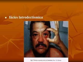  fácies latrodectísmica
 