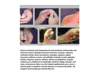 Entre os sintomas mais frequentes de uma picada de aranha estão: dor
intensa no local, salivação excessiva, tremores, náuseas, sudorese,
confusão mental, dores musculares, excitação, angústia, rigidez
muscular, ardência, coceira, vermelhidão, irritação na pele, agitação,
vômito, fraqueza, tontura, cefaleia, edema nas pálpebras, erupção
cutânea, pus, problemas na respiração, calafrios, fadiga, náuseas, mal
estar, urina escura, febre e se não tratado rapidamente com o soro, o
veneno pode se espalhar e formar edemas e a necrose do tecido. Na
Imagem acima picada por Aranha Marrom.
 