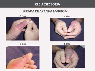 CLC ASSESSORIA 
PICADA DE ARANHA MARROM 
3 dias 4 dias 
5 dias 6 dias 
 